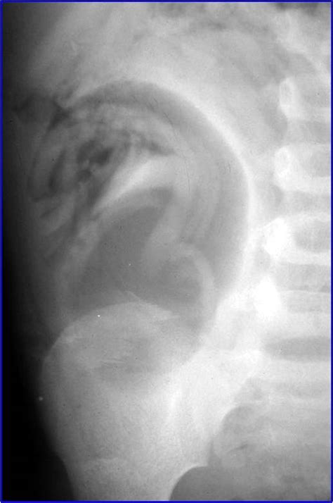 ascariasis in lungs.